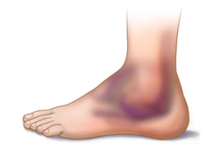 Sprained your ankle? - get some qualified help.
